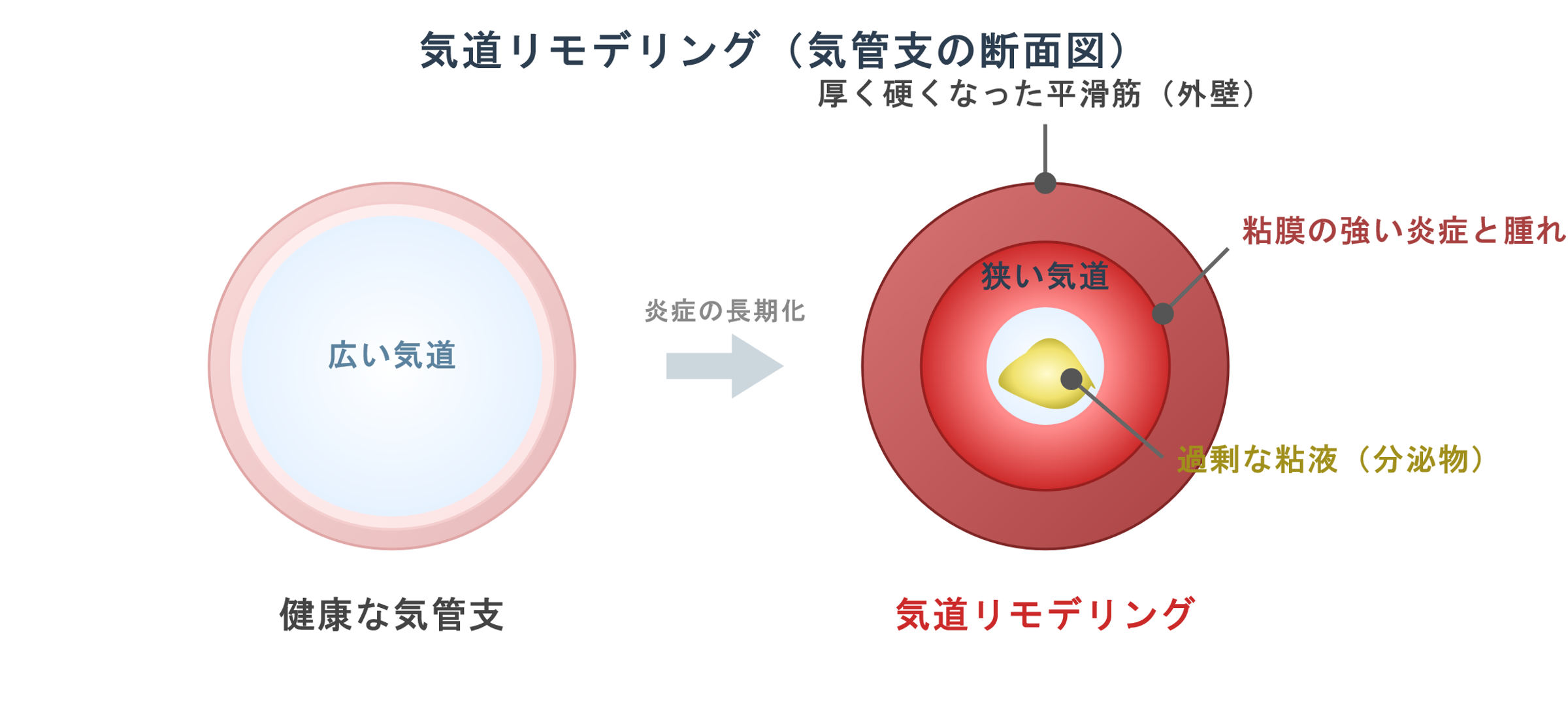 気道リモデリング(気管支の断面図)